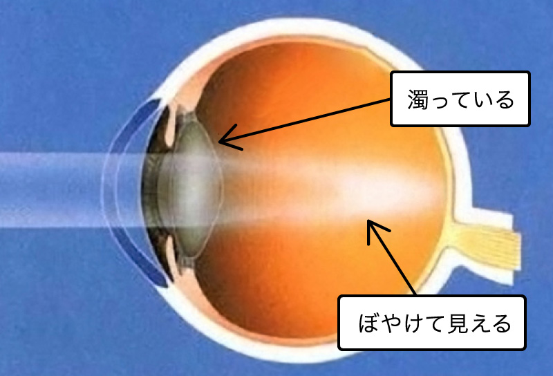 白内障 手術 後 の 見え 方 体験 談